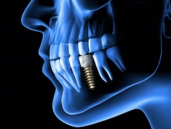 Principales cuidados de los implantes dentales