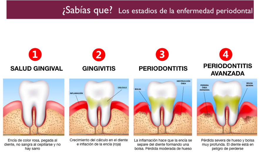 Prevenir la enfermedad periodontal es prevenir el riesgo cardiovascular