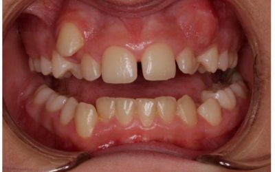 Ortodoncia con brackets (Antes y Después)