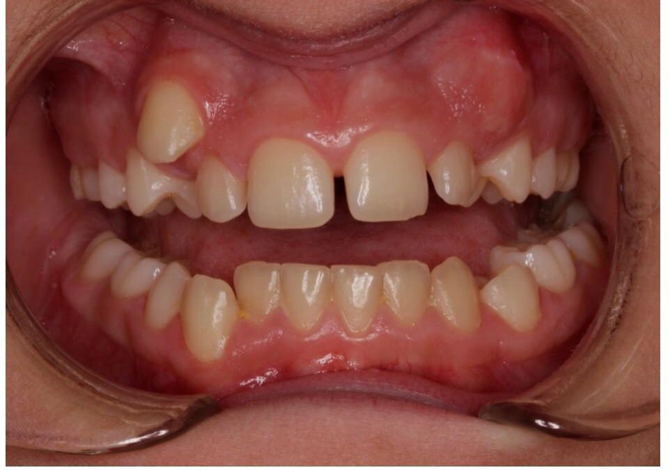 Ortodoncia con brackets (Antes y Después)